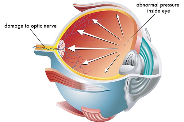Glaucoma Medial Illustration